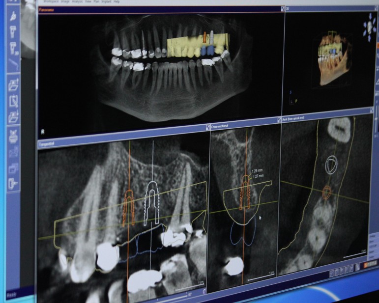 Dan D'Amico can use the 3-D X-rays on his computer to decide where to place a replacement tooth.