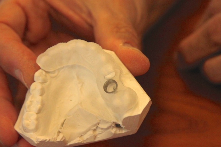 A surgical guide used at D'Amico Dental Care to precisely place replacement teeth.